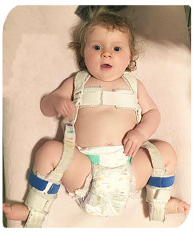 hip-dysplasia-pavlik-harness-last-day.jpg